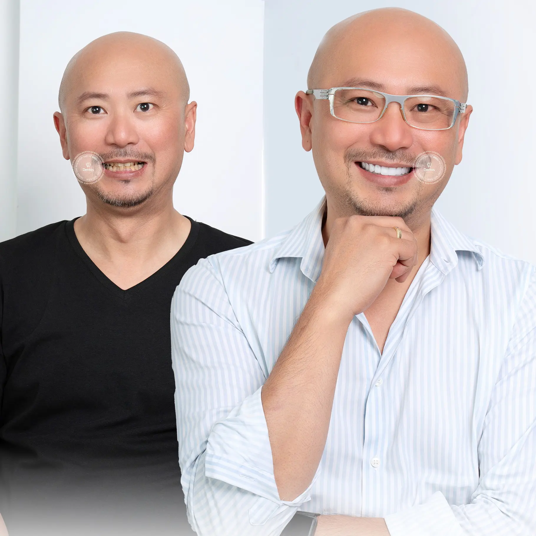 Kết quả dán sứ Veneer cho nam giới – nụ cười trắng sáng nhưng vẫn tự nhiên